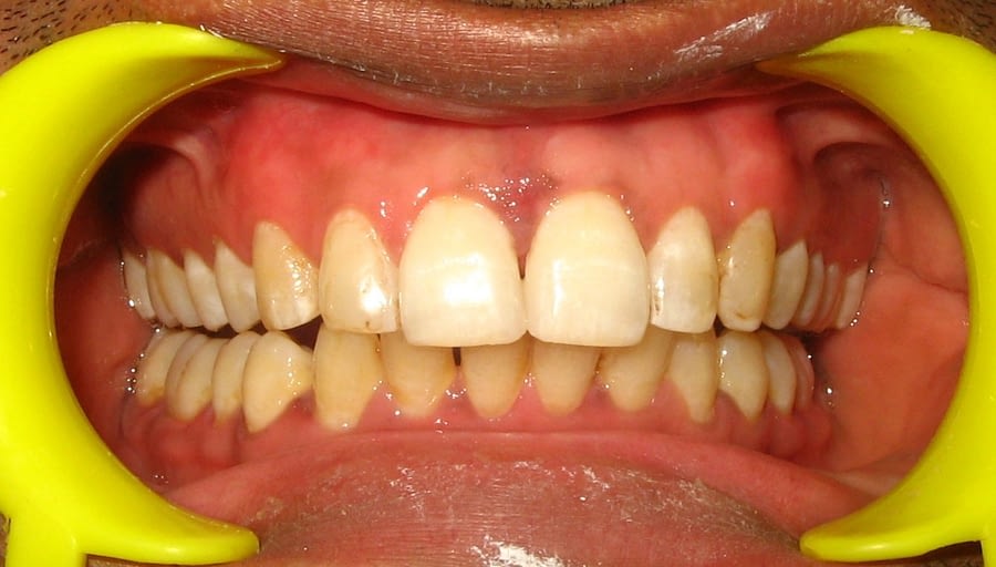 Diastema Closure composite bonding