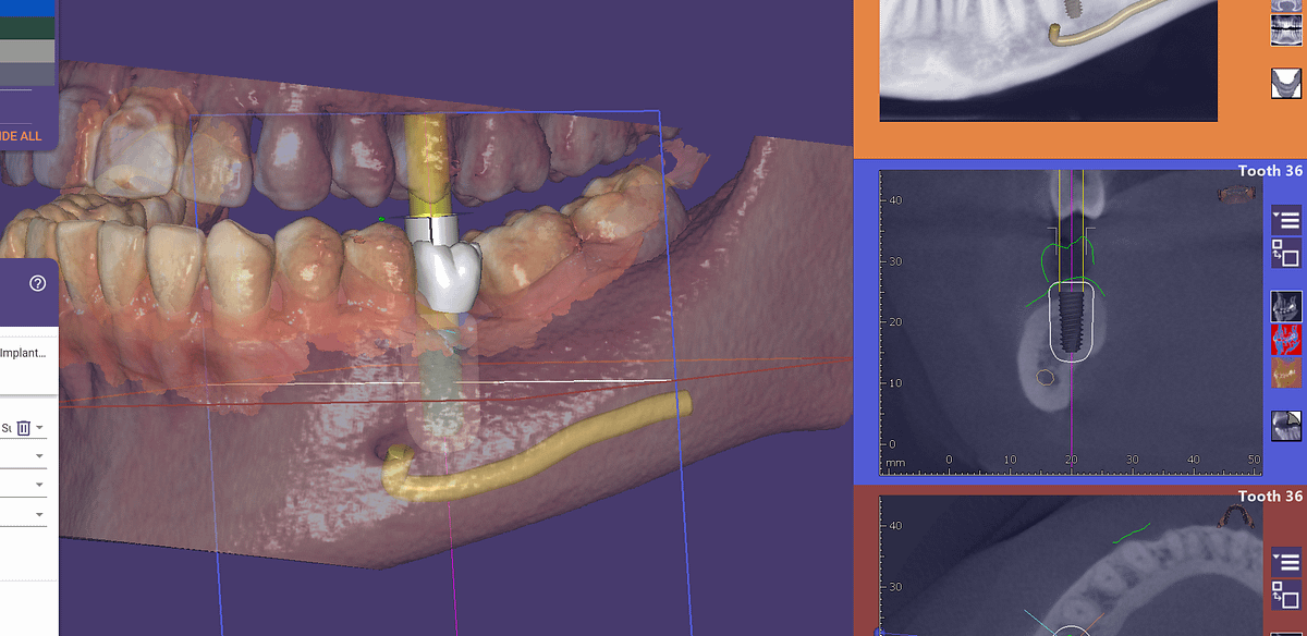 Digital Planning for Dental Implants. Best Dentist in noida
