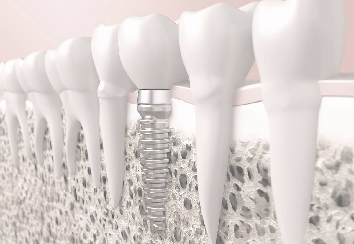 Best centre for Dental Implant noida