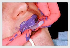 Traditional dental impression Messy and gag reflex
