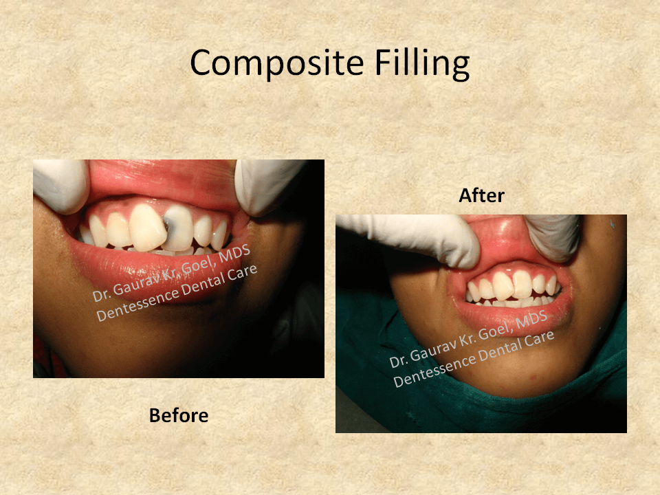 Anterior Composite Filling One of the Most Advanced Digital Dentistry